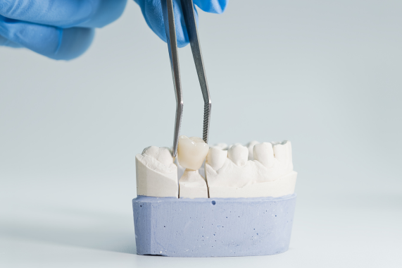 Prótese Dentária e Implantes Dentários